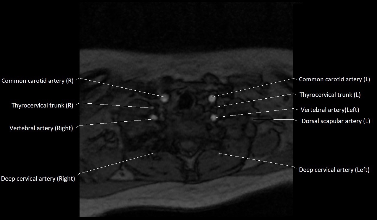 Carotid artery anatomy axial 3T image 63.jpg
